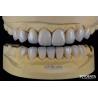 Buy cheap Advanced Ceramic Porcelain Veneers Biocompatible Shade Matched for a Natural from wholesalers