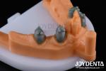 Precision Removable Prosthesis Dental Implant Attachments Easy Clean Comfortable
