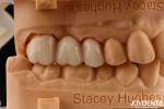 High Flexural Strength Full Contour Zirconia For Crowns Bridges Dental