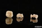 Natural Polymerized Porcelain Dental Inlay Onlay For Tooth Restoration