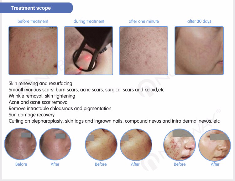 UltraPulse RF Tube Fractional CO2 Laser Vaginal Tightening/Skin Resurfacing Unit NBW-FII