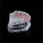 ODM Modified Hawley Removable Retainer Post Orthodontic Appliance