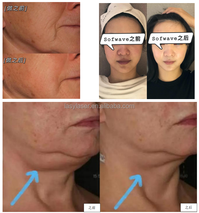 Ultrasound RF Face Wrinkle Removal Machine Anti Puffiness Anti Aging
