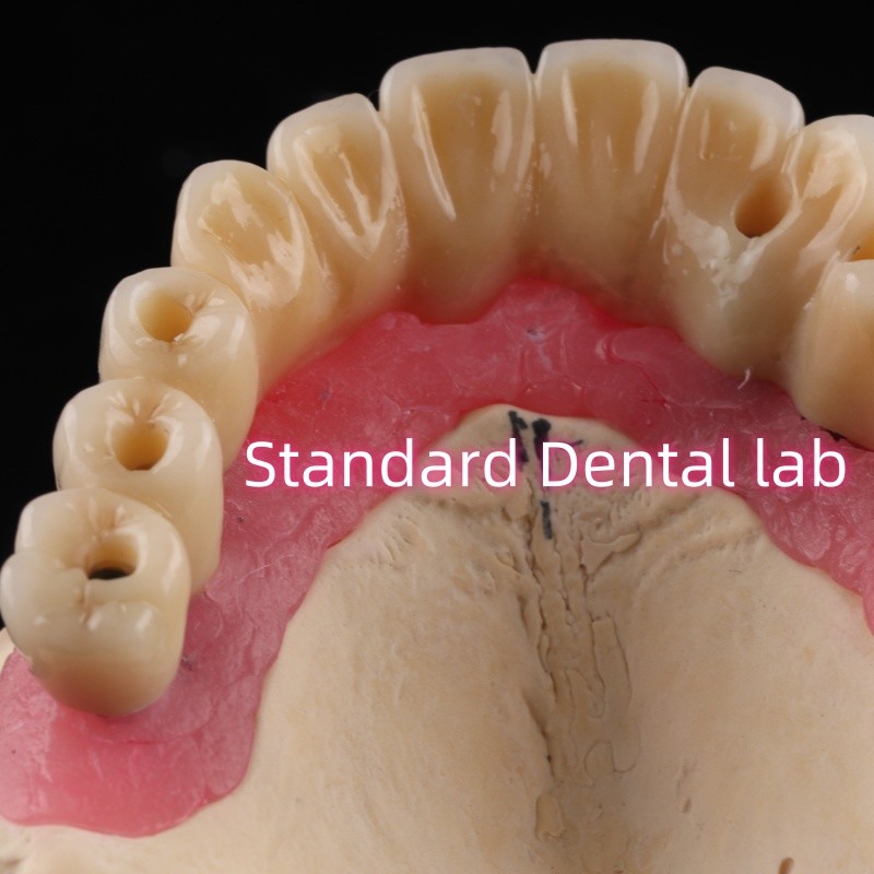 Zirconia Implant Bridge Screw Retained With Pink Gum Porcelain