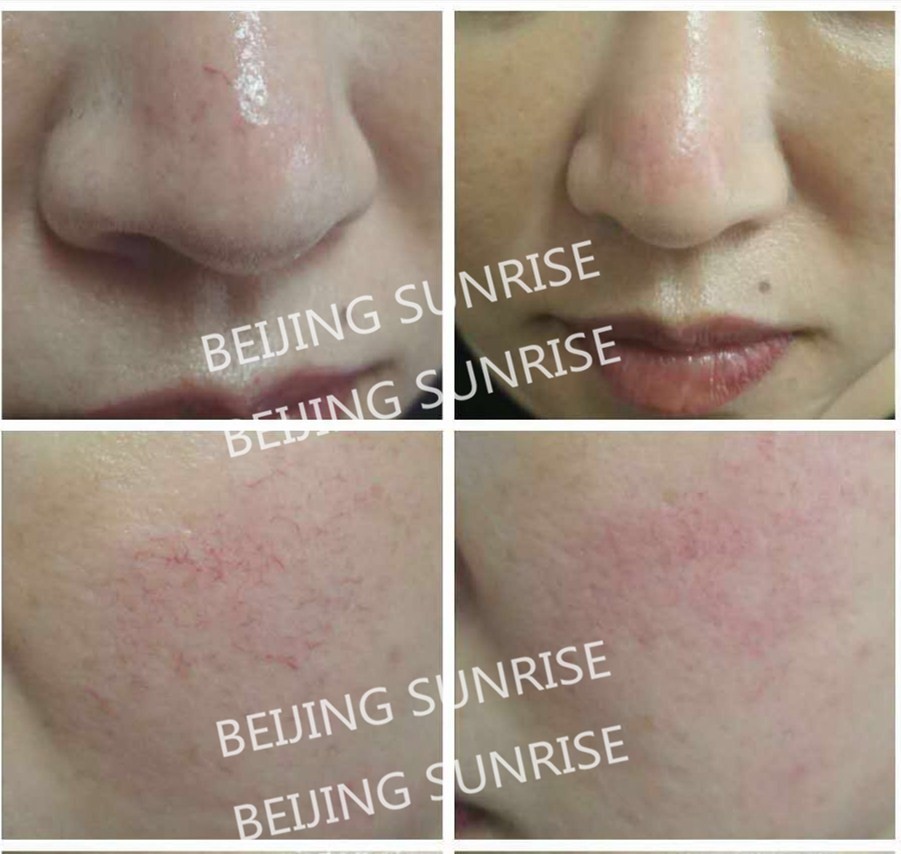 pain relief acupuncture therapy light therapy infrared machine laser