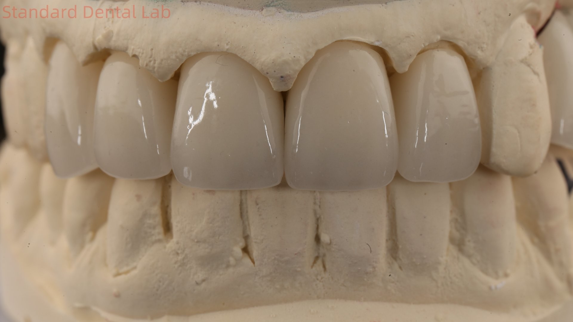 China Dental Lab Zirconia Full Contour Crown High Aesthetic Natural Dental Bridge 5 Year Guarantee