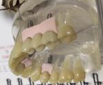 100 Percent Biocompatibility PMMA Provisional Crown