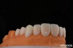 A1-A4 Ips Emax Press Porcelain Dental Veneers Stain Resistant Customizable Shape