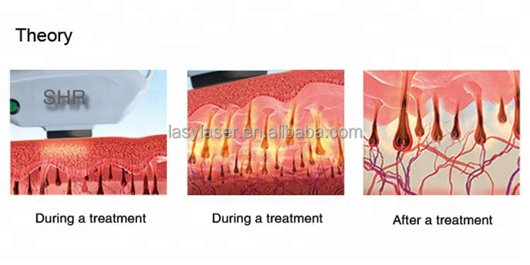 OPT Vascular DPL Laser Hair Removal Shr Skin Resurfacing Machine