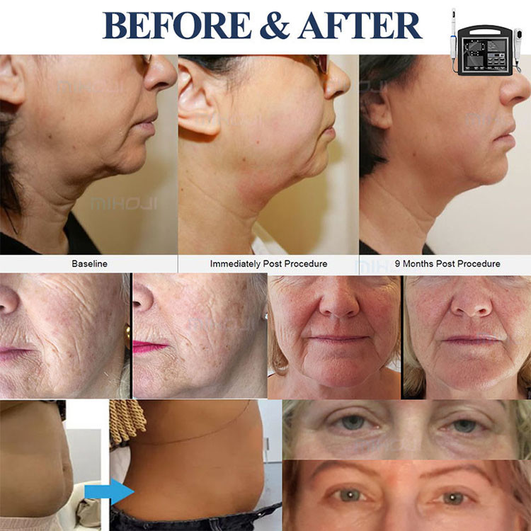 Ultrasound Hifu Facial Machine 4D Portable Skin Tightening for Beauty Salon