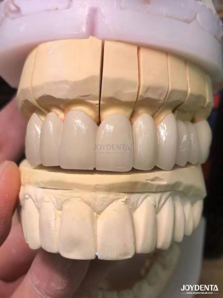 Precision Fit Porcelain Fused to Metal PFM Crowns Seamless Natural Smile
