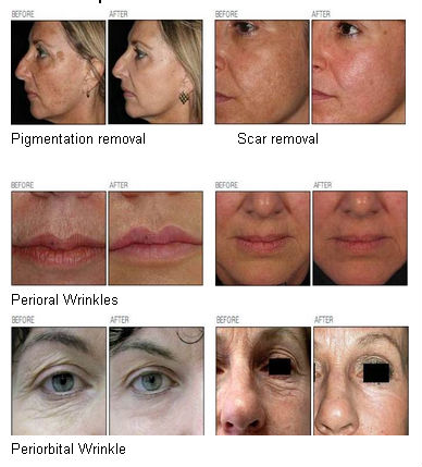 Multifunction medical laser co2 fractional/fractional co2 laser/co2 fractional laser CE/FDA approval