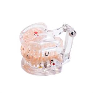 Quality 32 Tooth Full Month Implant Disease Teeth Model Clear Design Dental Pathology Model wholesale