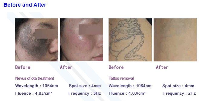 6mm YAG Bar Q Switch Laser Machine Tattoo Removal 1064nm 532nm 1320nm