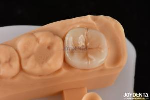Quality 0.5mm-2mm Precise Fit Emax Dental Inlay Onlay For Reliable Tooth Restoration wholesale