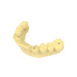 Temporary Crown Biocompatible Resin Dental Bridge Photosensitive Resin