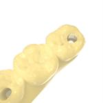 Dental Bridge Photosensitive Resin Non Toxic Temporary Resin Crown