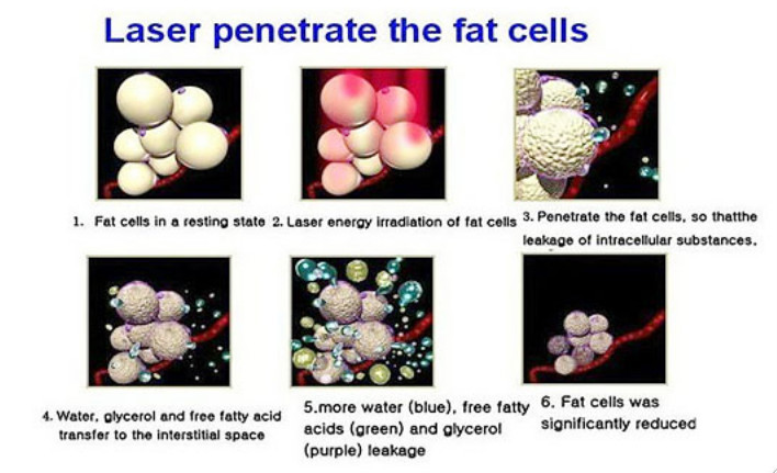 lipo laser slimming machine thrapy