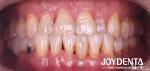 Customizable Dental Maryland Resin Bonded Bridges for Anterior And Premolar