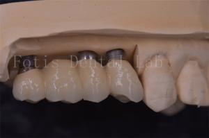 Quality Precision Fit Dental Implant Crowns Titanium / Zirconia / PFM Restoring Missing Teeth wholesale