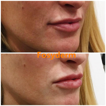 2ml Acido Hialuronico Dermal Lip Fillers Gel For Lip Enhancer , CE / ISO