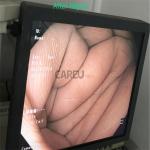 Medical Device Repair Cases Of Olympus CF-H190L Colonoscope for repair