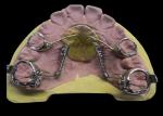 Mouthpieces Dental Tooth Orthodontic Appliances , Orthodontic Ligature Ties
