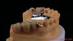 CorCr Metal Partial Denture High Light Beryllium Free Ivoclar Scheftner