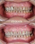 Lightweight Dental Zirconia For Optimal Patient Experience Natural Color