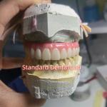 Screw Retained Titanium PMMA Dental Bridge Temporary Crown