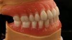 Heat Cured Ivoclar Full Acrylic Denture Dental Lab High Accuracy High Esthetic
