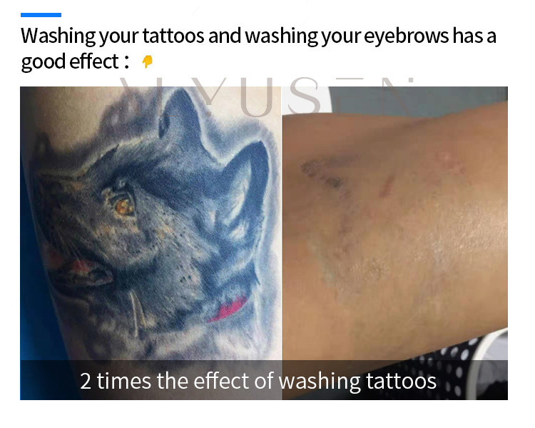Q Switched Nd Yag Picosecond Laser Tattoo Removal Machine Skin Whitening