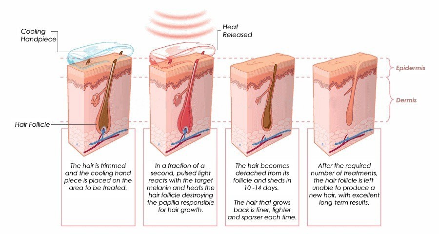 600W Diode Laser 808nm Hair Removal Machine For Skin Tightening / Rejuvenation