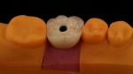 Screw Retained PFZ Porcelain Layered Zirconia Dental Implant Crown from Dental