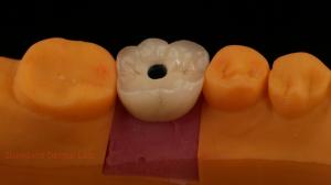Quality Screw Retained PFZ Porcelain Layered Zirconia Dental Implant Crown from Dental Lab ISO FDA CE Certified with 5-Year Guarantee wholesale