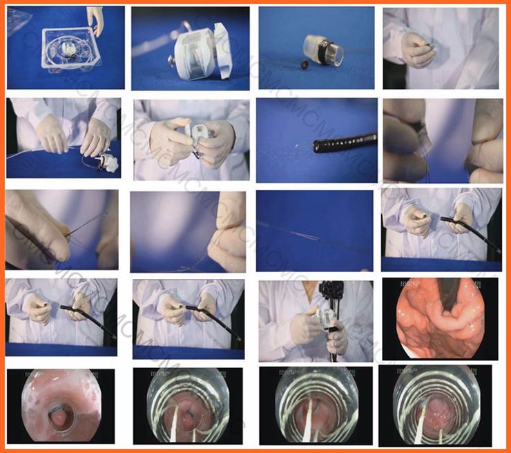 Endoscopic Rubber Band Ligator 10mm Endoscopy Accessory