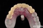 High Transparency PMMA Dental Material Natural Color Lifelike Aesthetics