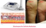 acoustic wave therapy magnetic wave therapy ultrasonic slimming equipment