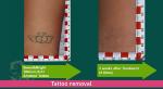 Commercial Q Switched Laser Tattoo Removal Machine 1064nm 532nm 755nm