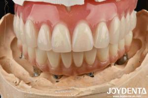 Quality Good Elasticity Dental Acrylic Denture Finish With Tooth Arrangement Technology wholesale