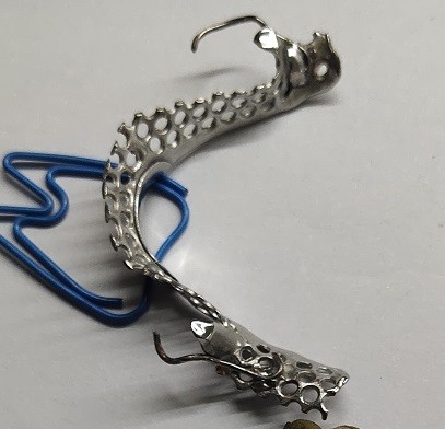 Removable 3D Printed Partial Denture Metal Framework