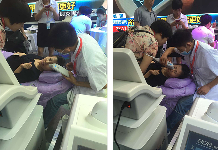 hifu machine / high intensity focused ultrasound hifu for wrinkle removal / hifu face lift
