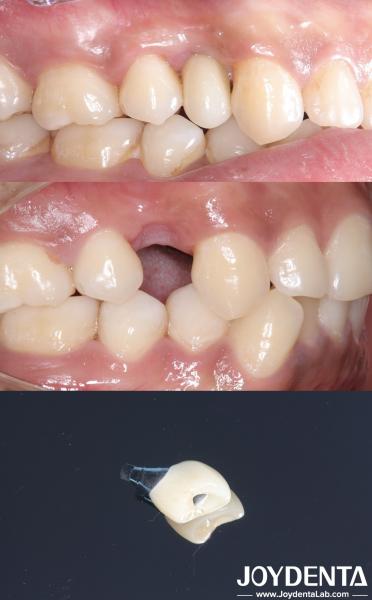 All On 4 Dental Tooth Implant Cylindrical Shape Titan Implant Dental Rough