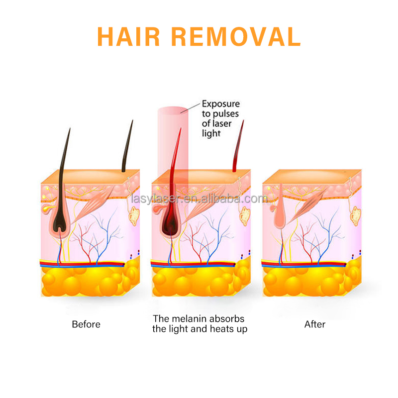 755 808 Laser Hair Removal Machine Permanent 1064 SHR OPT IPL Epilation Definitive