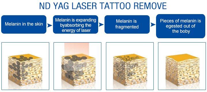 7 Joints Laser Skin Rejuvenation Machine 500-800ps Nd Yag