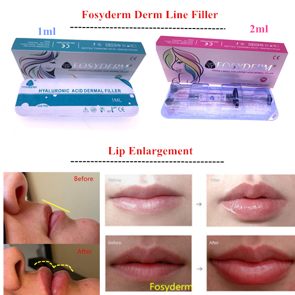 Anti Wrinkle Lips Face Oem Cross Linked Dermal Filler Injection
