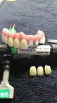 Flexible Individual Titanium Removable Dental Crown For Dental Clinic