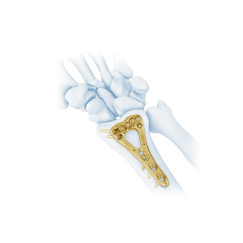 Medical Orthopedic Multi-Axial Distal Radius Medial Locking Plate