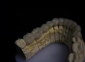 Quality Layered Porcelain Fused Zirconia wholesale