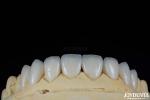 Glossy Surface Texture Feldspathic Veneer Natural Looking Porcelain Veneer